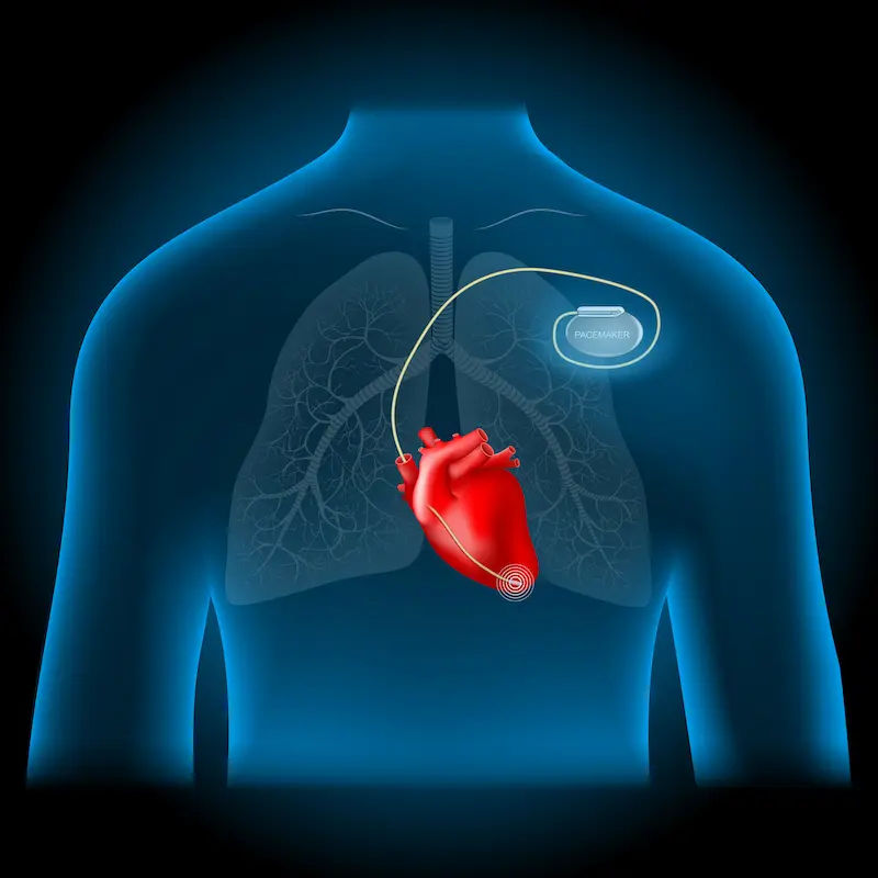 Guide to New Generation Pacemakers What to Know